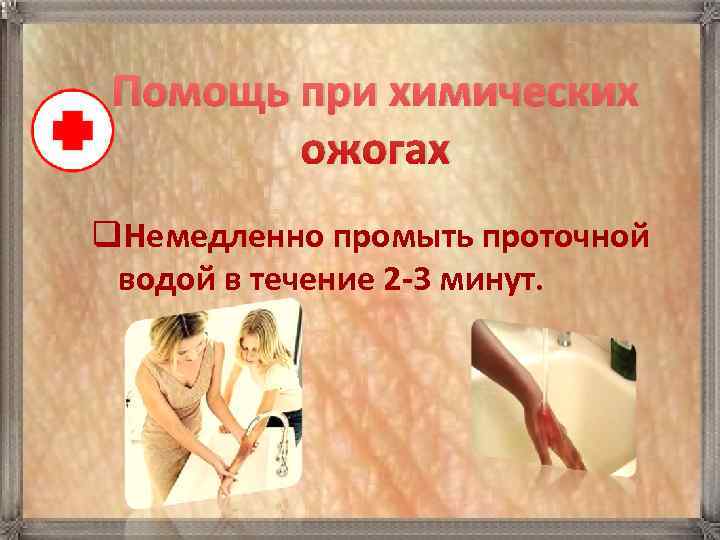  Помощь при химических   ожогах q. Немедленно промыть проточной  водой в
