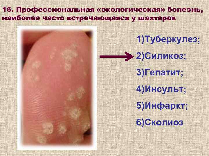 16. Профессиональная «экологическая» болезнь, наиболее часто встречающаяся у шахтеров     