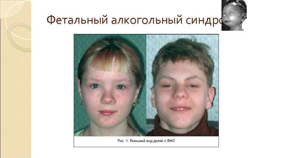 Фетальный алкогольный синдрома Фетальный алкогольный синдрома