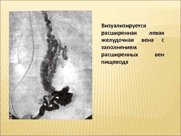 Визуализируется расширенная левая желудочная вена с заполнением расширенных  вен пищевода  