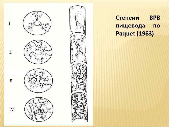 Степени ВРВ пищевода по Paquet (1983) 