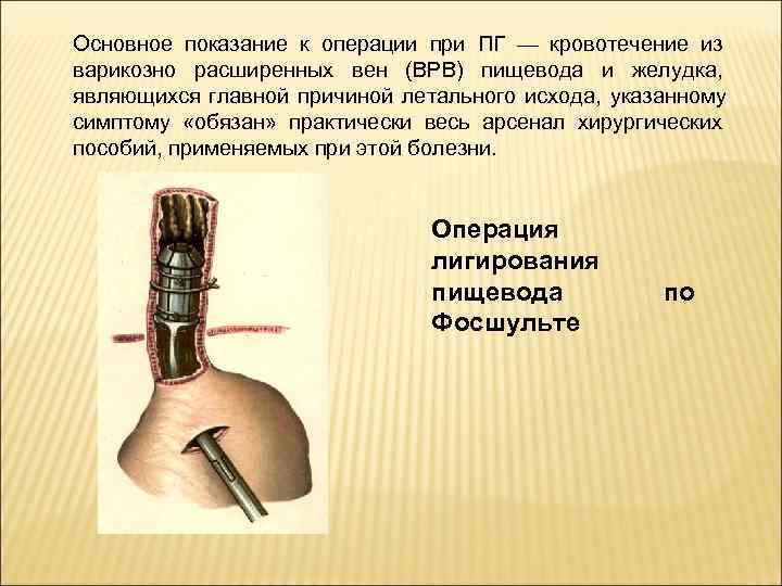 Кровотечение пищевода. Операция при кровотечении из варикозно расширенных вен пищевода. Операции при пищеводном кровотечении. Показания к операции при кровотечении.. Хирургическая тактика при кровотечении из варикозно-расширенных.