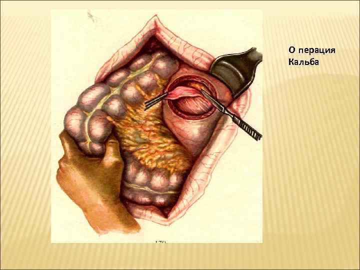 О перация Кальба 