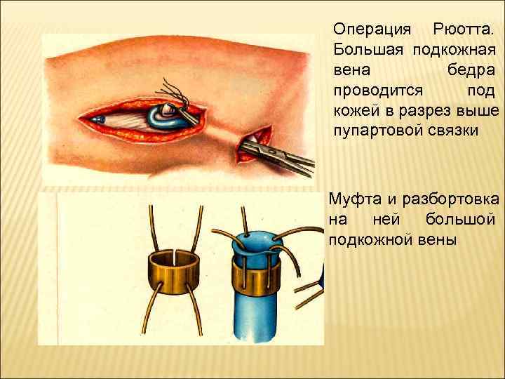 Операция Рюотта.  Большая подкожная вена   бедра проводится под кожей в разрез