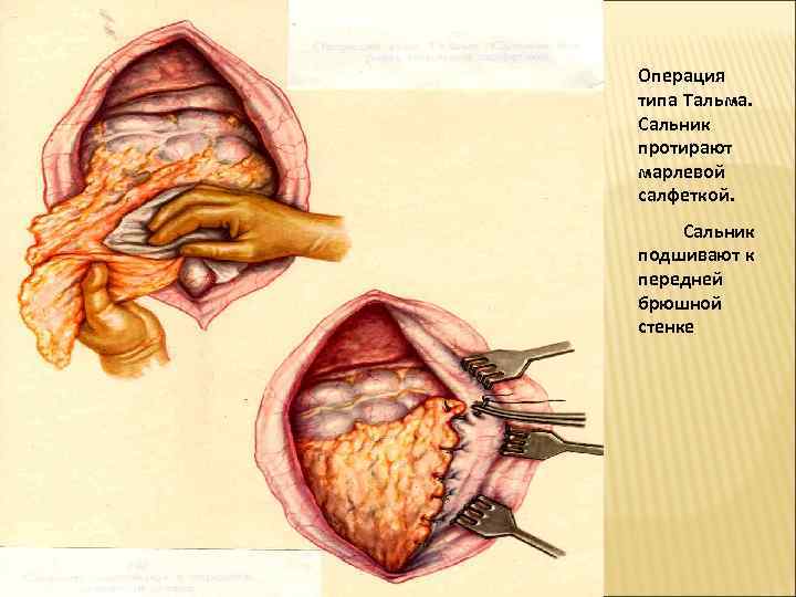 Операция типа Тальма.  Сальник протирают марлевой салфеткой.  Сальник подшивают к передней брюшной