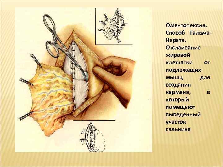 Оментопексия.  Способ Тальма- Нарата.  Отслаивание жировой клетчатки  от подлежащих мышц 