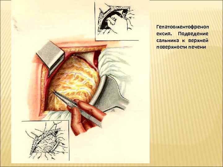 Гепатооментофреноп ексия.  Подведение сальника к верхней поверхности печени 