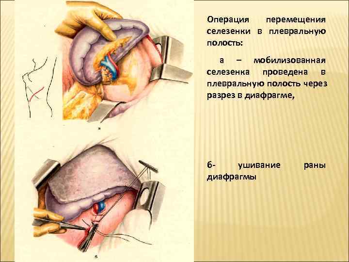 Операция перемещения селезенки в плевральную полость:  а – мобилизованная селезенка проведена в плевральную