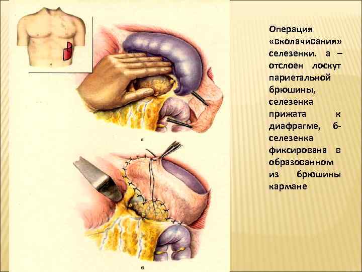Операция  «вколачивания»  селезенки.  а – отслоен лоскут париетальной брюшины,  селезенка