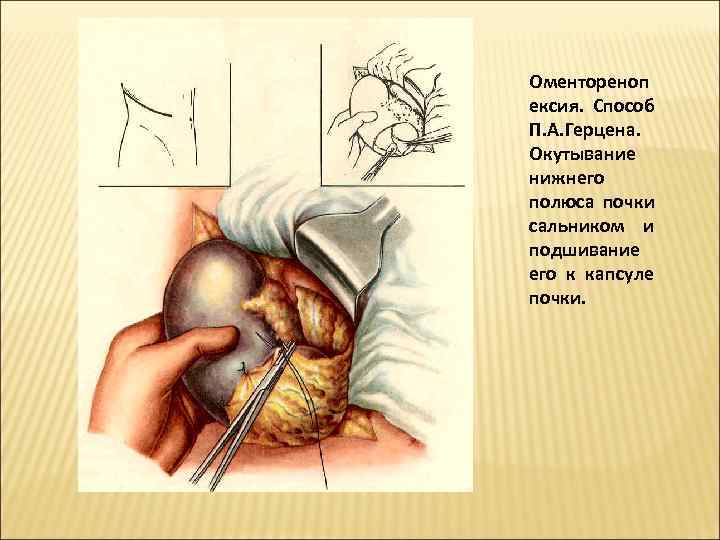 Оментореноп ексия.  Способ П. А. Герцена.  Окутывание нижнего полюса почки сальником и
