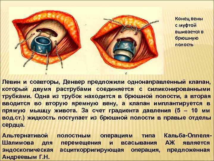      Конец вены      с муфтой