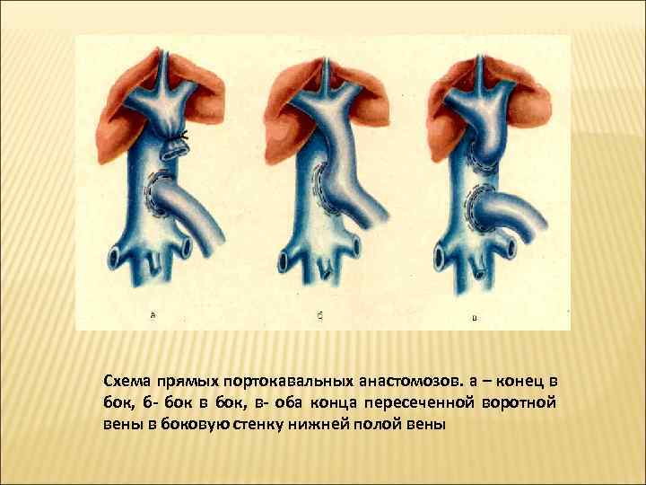 Схема прямых портокавальных анастомозов. а – конец в бок,  б- бок в бок,