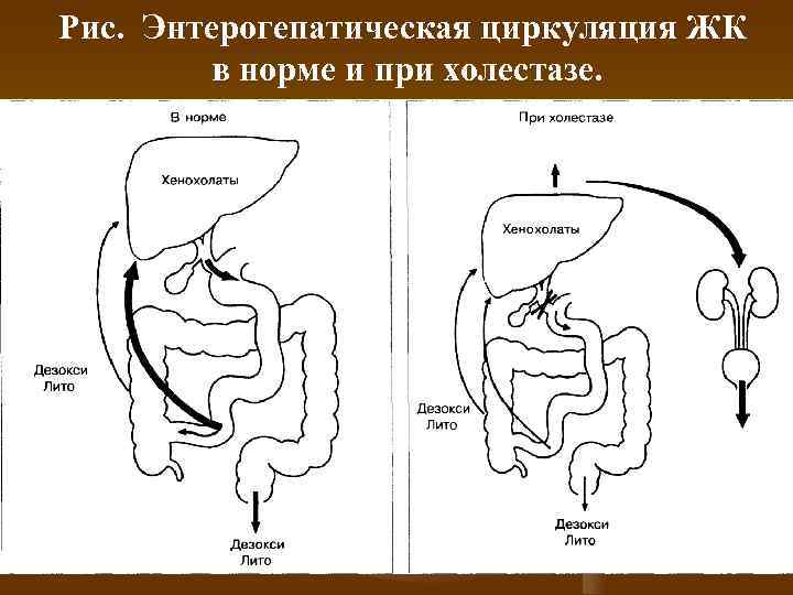 Рис.  Энтерогепатическая циркуляция ЖК  в норме и при холестазе. 