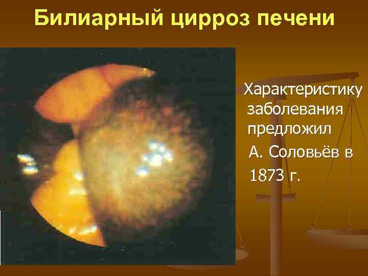 Билиарный цирроз печени   Характеристику    заболевания    предложил