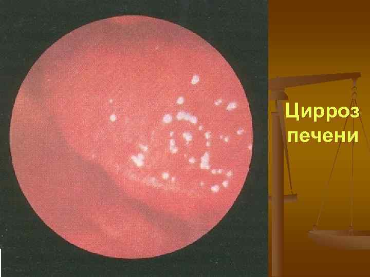 Цирроз печени 
