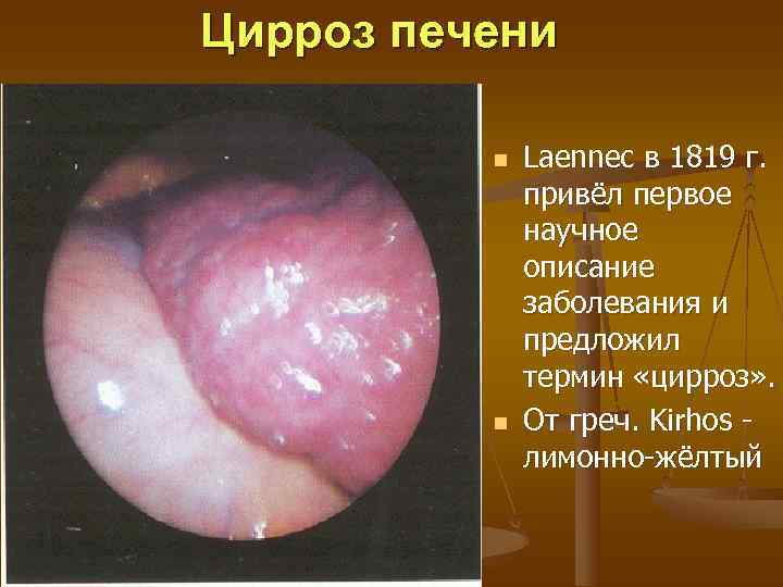 Цирроз печени  n  Laennec в 1819 г.    привёл первое