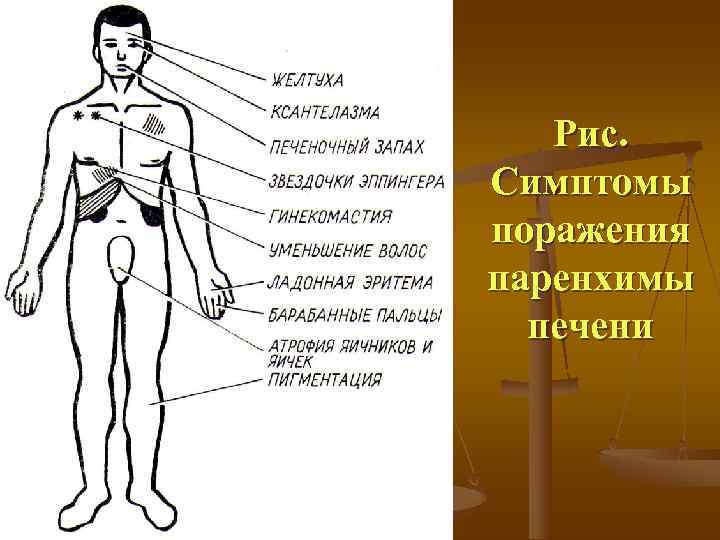   Рис.  Симптомы поражения паренхимы  печени 