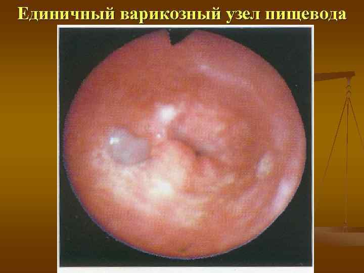 Единичный варикозный узел пищевода 