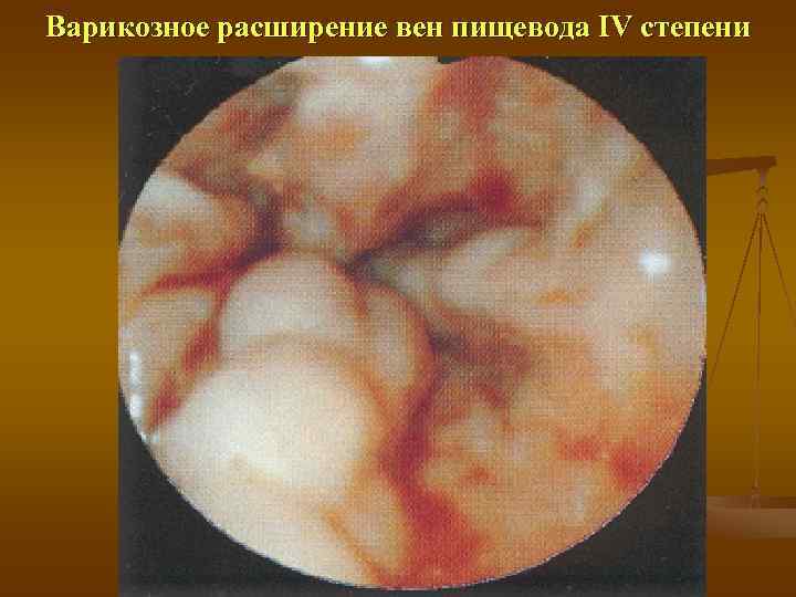 Варикозное расширение вен пищевода IV степени 