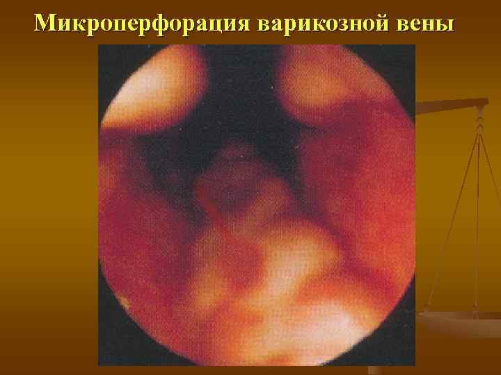 Микроперфорация варикозной вены 