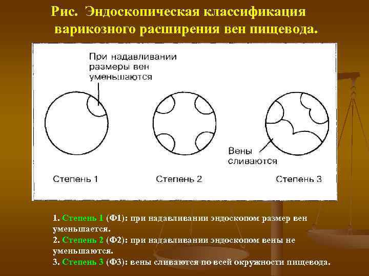 Рис.  Эндоскопическая классификация варикозного расширения вен пищевода. 1. Степень 1 (Ф 1): при