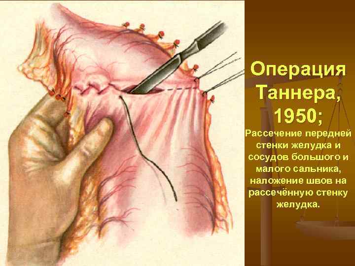 Операция Таннера,  1950; Рассечение передней  стенки желудка и сосудов большого и 