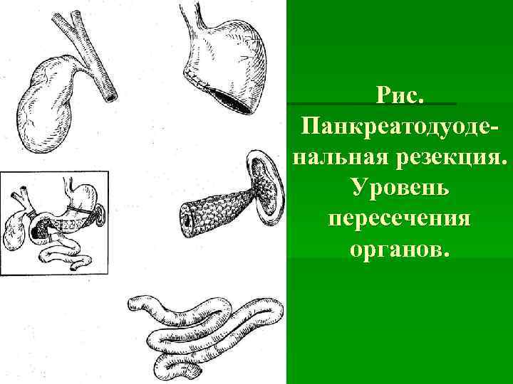   Рис.  Панкреатодуоде нальная резекция.  Уровень  пересечения органов. 