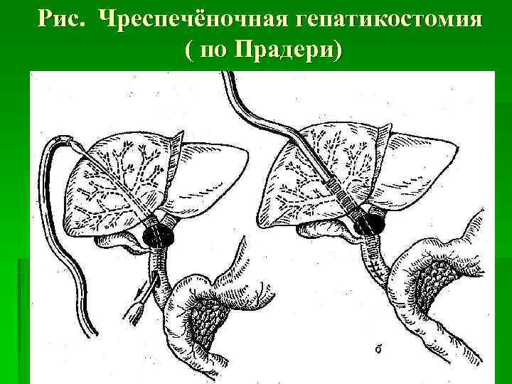 Рис. Чреспечёночная гепатикостомия  ( по Прадери) 