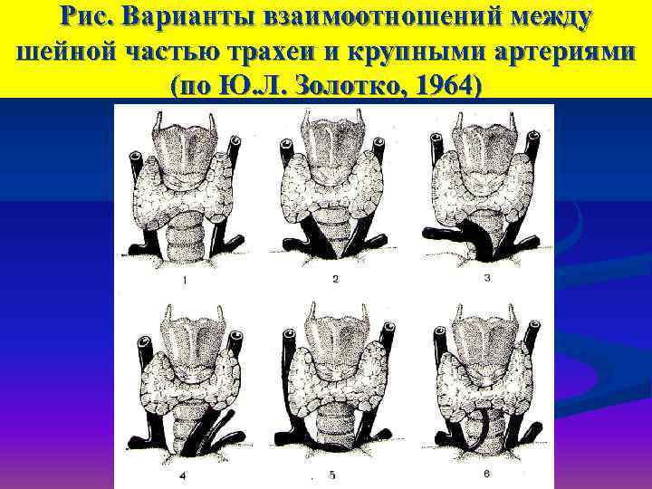  Рис. Варианты взаимоотношений между шейной частью трахеи и крупными артериями  (по Ю.