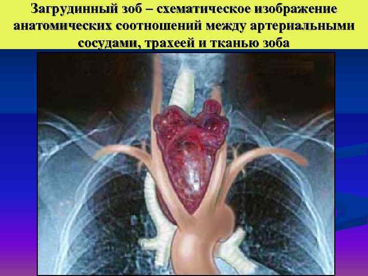  Загрудинный зоб – схематическое изображение анатомических соотношений между артериальными   сосудами, трахеей