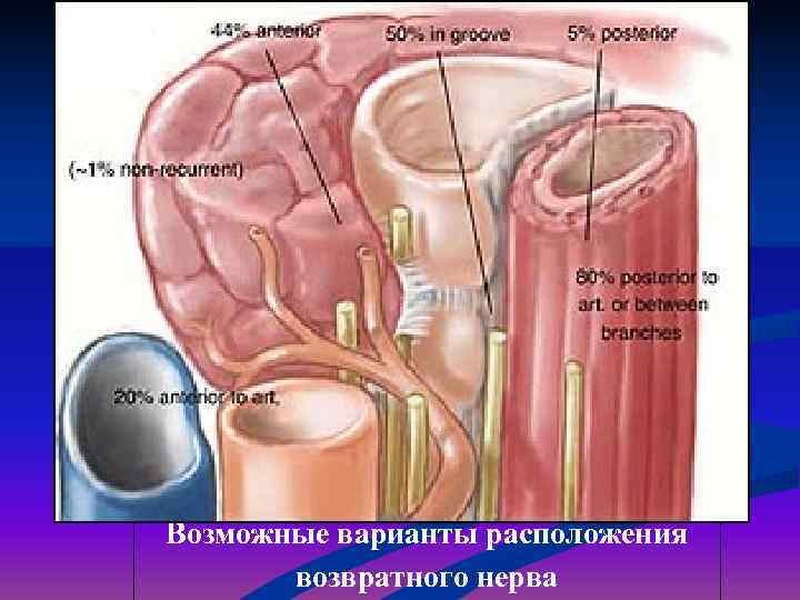 Возможные варианты расположения  возвратного нерва 