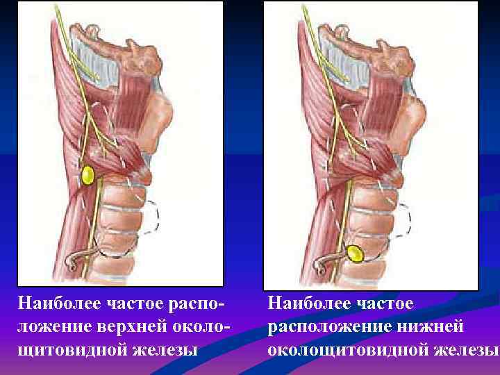 Наиболее частое распо-  Наиболее частое ложение верхней около-  расположение нижней щитовидной железы