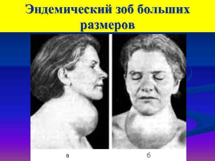 Эндемический зоб больших  размеров 