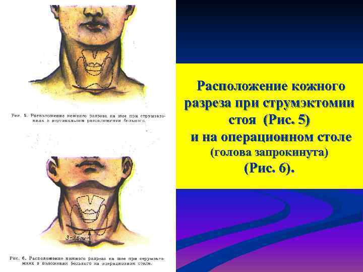  Расположение кожного разреза при струмэктомии  стоя (Рис. 5) и на операционном столе
