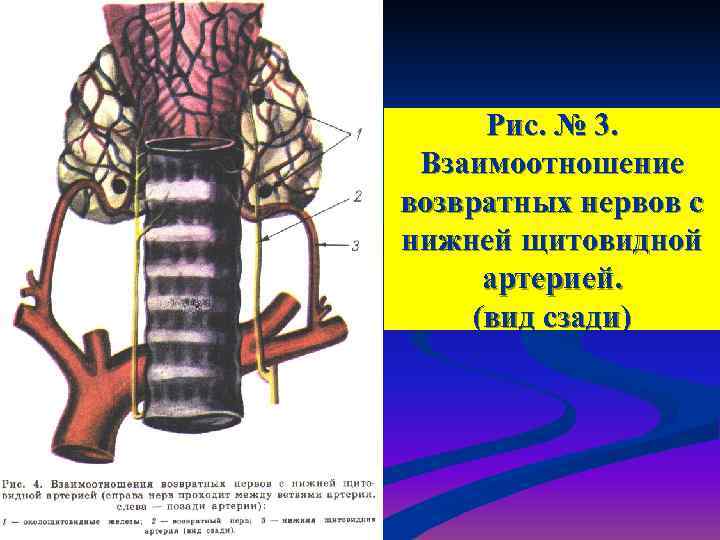  Рис. № 3.  Взаимоотношение возвратных нервов с нижней щитовидной  артерией. 