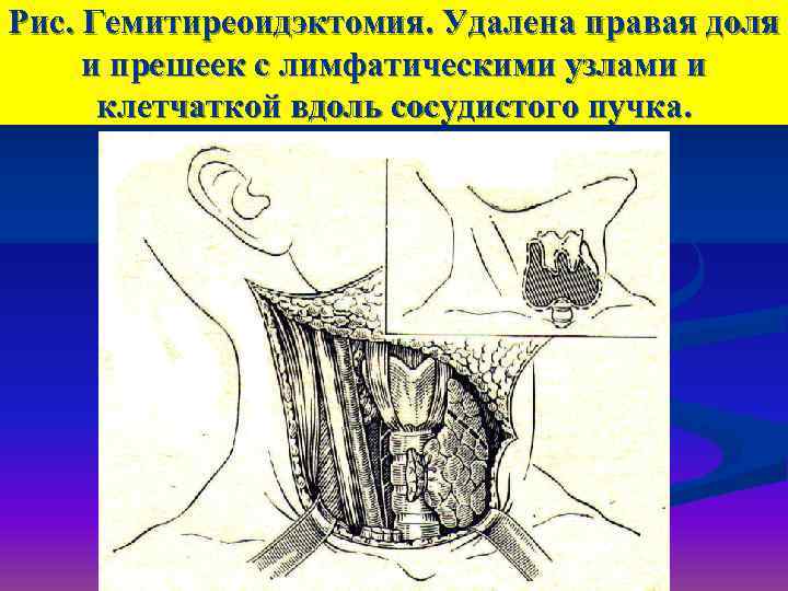 Рис. Гемитиреоидэктомия. Удалена правая доля и прешеек с лимфатическими узлами и  клетчаткой вдоль