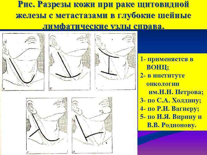Рис. Разрезы кожи при раке щитовидной железы с метастазами в глубокие шейные  лимфатические