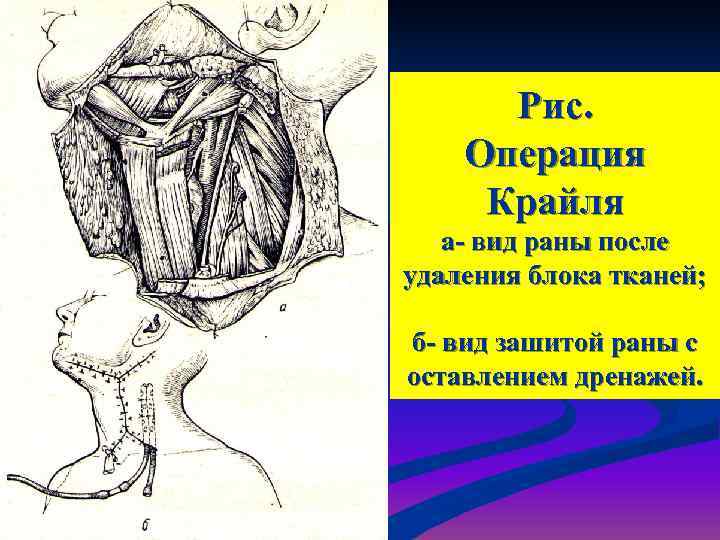  Рис. Операция Крайля  а- вид раны после удаления блока тканей;  б-