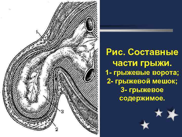 Грыжевой мешок