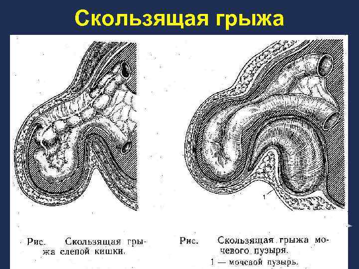 Скользящая грыжа