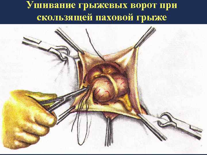 Ушивание грыжевых ворот при скользящей паховой грыже 