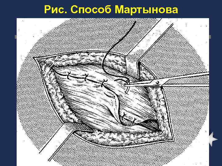 Рис. Способ Мартынова 