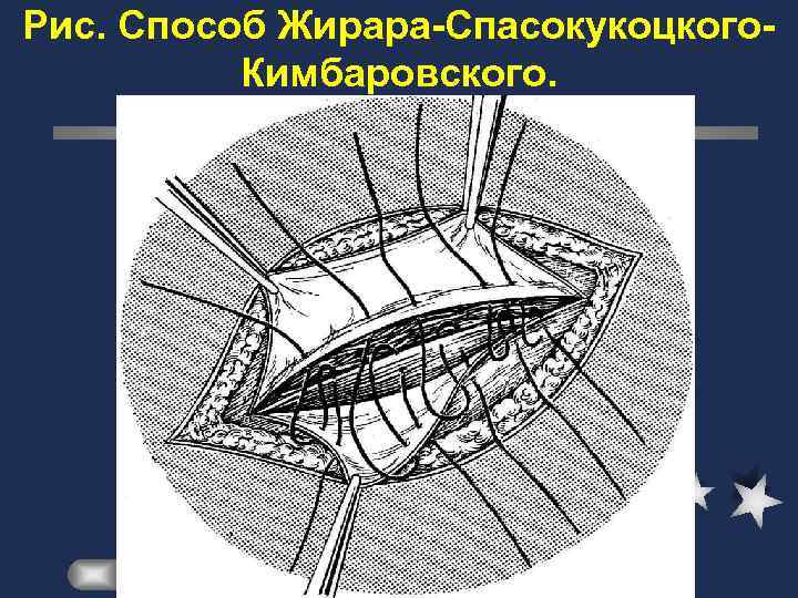 Пластика пахового канала по жирару