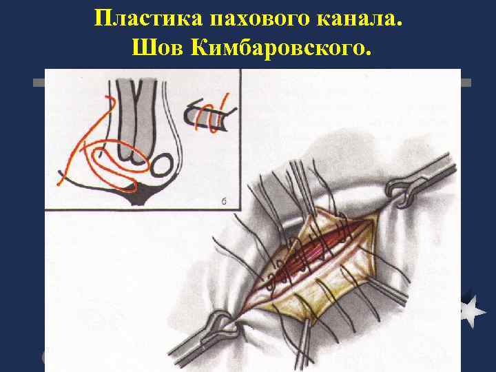 Пластика пахового канала по кимбаровскому