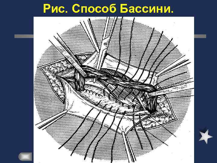 Пластика пахового канала по бассини