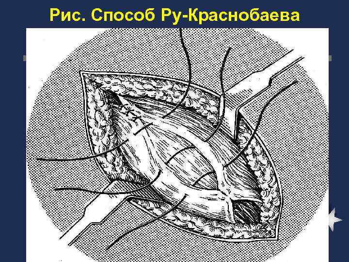 Пластика по краснобаеву пахового канала