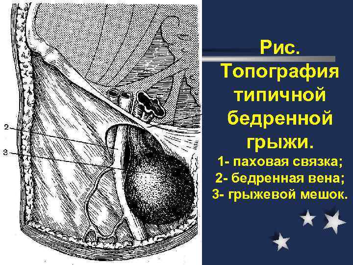 Бедренные грыжи топографическая анатомия презентация