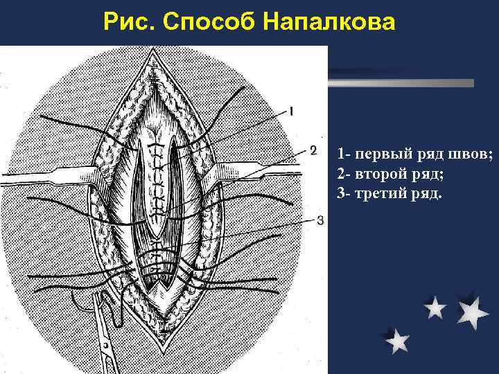 Грыжи факультетская хирургия презентация