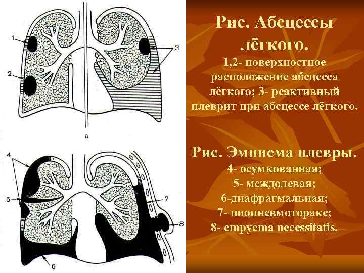   Рис. Абсцессы  лёгкого.  1, 2 - поверхностное  расположение абсцесса