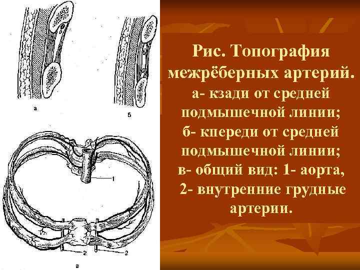  Рис. Топография межрёберных артерий. а- кзади от средней подмышечной линии;  б- кпереди